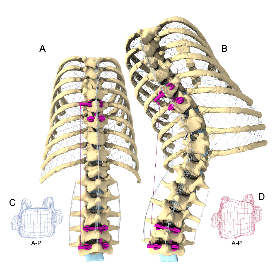 Porcine spine finite element modeling of scoliosis-like growth modulation